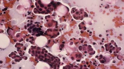 infección por el virus del papiloma humano de alto riesgo infección por el virus del papiloma humano de alto riesgo