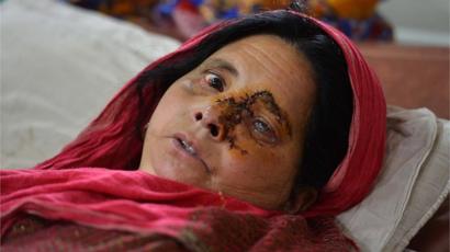 امرأة مصابة في عينها