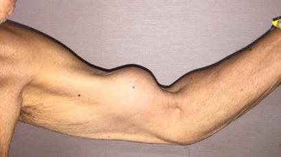 sintomas de desgarro muscular en el brazo