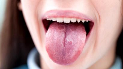 como curar la lengua blanca naturalmente