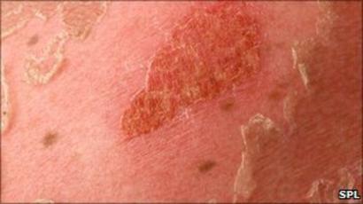 Skin Cancer Campaign For Over 50s To Begin In Dorset Bbc News
