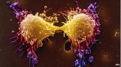 cáncer de próstata erlitar