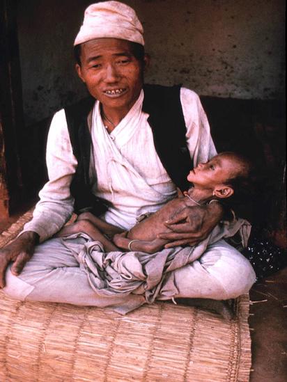 Father and baby son with advanced TB at Dhankuta at the newly opened TB clinic in about 1969