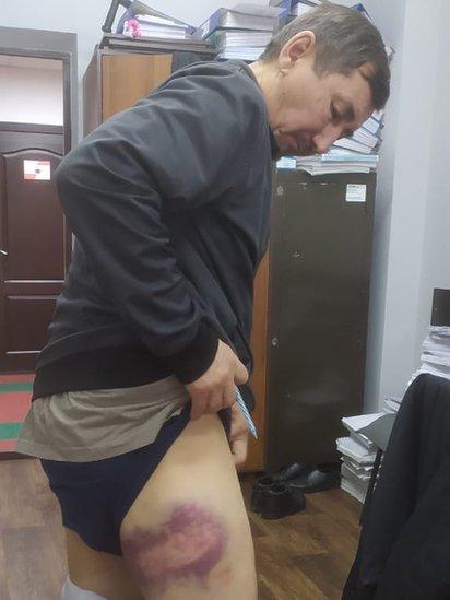 Muratbek Yesengazy shows his leg covered in bruises