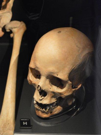 Man's skull with healed arrow wound on the top of his head