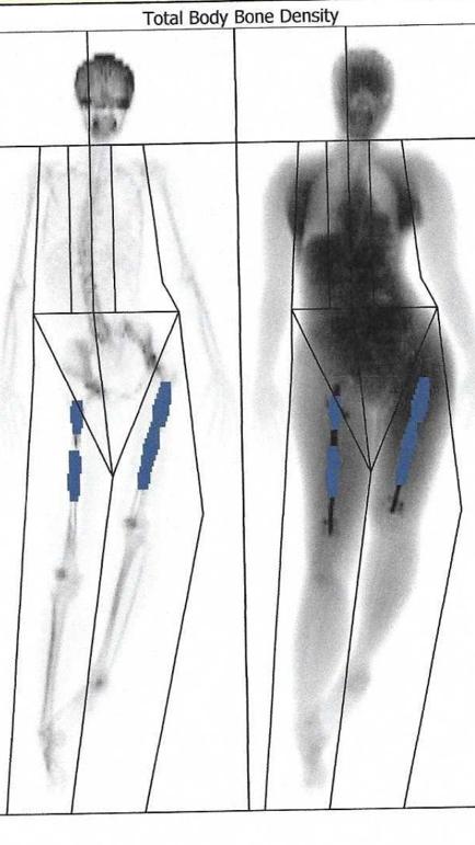 A scan showing Elaine's lengthened right leg beside her unlengthened left leg.