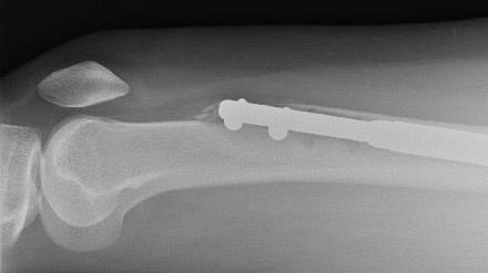 A scan of Elaine's left femur showing a metal rod breaking through the bone.