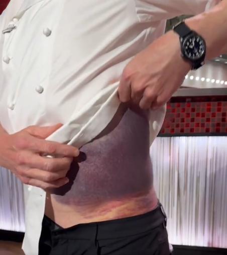 Gordon Ramsay shows his bruise after cycling accident