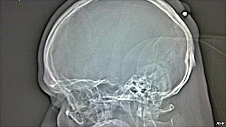 X-ray showing the bullet lodged in the man's head (24 August 2010)