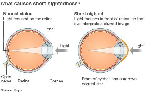 Graphic showing how myopia affects the eye
