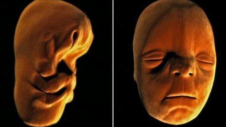 Human embryo at 1 month and 10 weeks