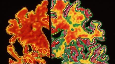 Alzheimer's brain (left) compared with healthy brain (right)