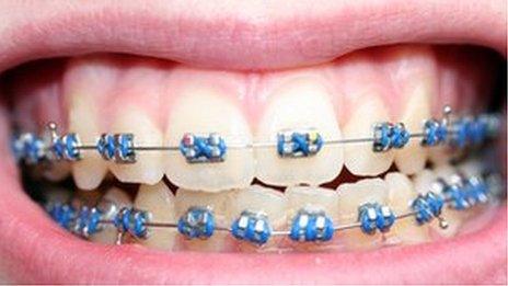 Braces on teeth