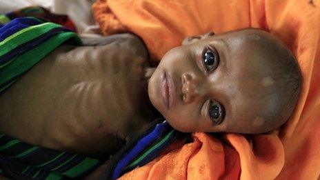 A severely malnourished Somali child at a refugee camp in Dadaab, Kenya - July 2011