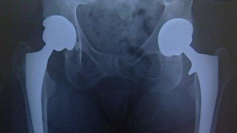 Hip replacement X-ray