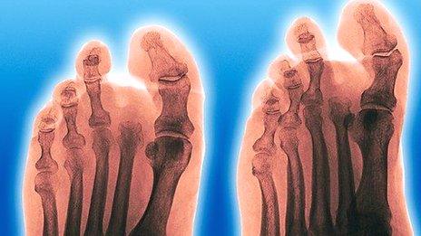 X-ray of amputated toe