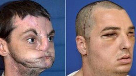 Pictures of Richard Norris before (L) and after his face transplant
