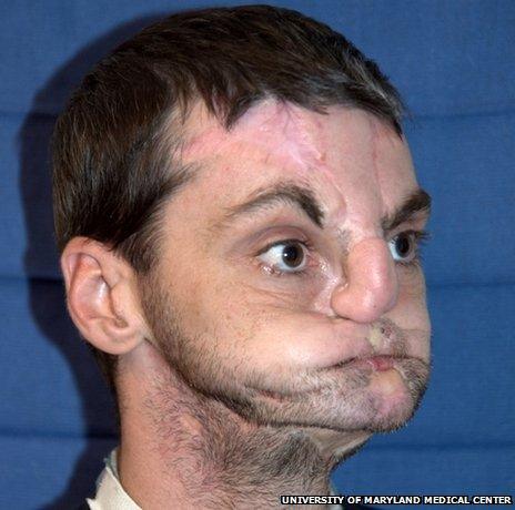 Richard Norris before his face transplant operation (Photo: University of Maryland Medical Center)
