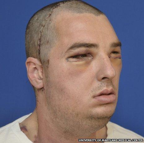 Richard Norris after his face transplant operation (Photo: University of Maryland Medical Center)