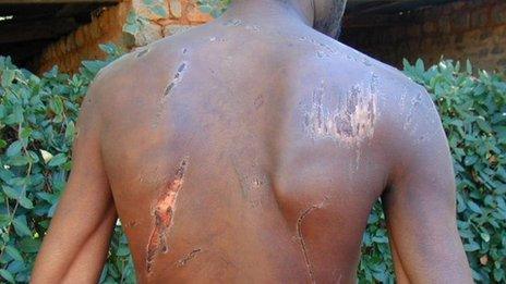 Zimbabwean victim of torture