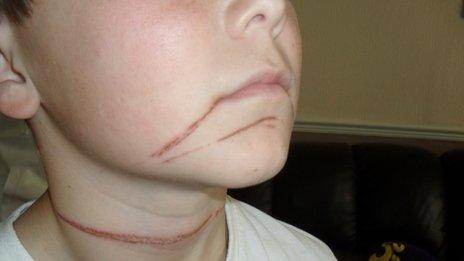 Appeal after Treharris boy, 12, cut by cycle path rope - BBC News