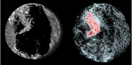 Comparison of normal CT and EST scans