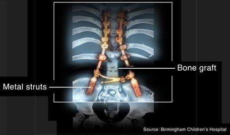 X-ray with graphics showing the position of metal struts and a bone graft