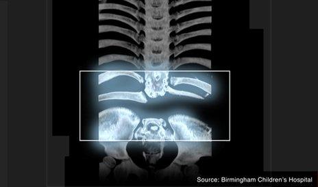 X-ray showing Rosie's spine with five vertebrae missing