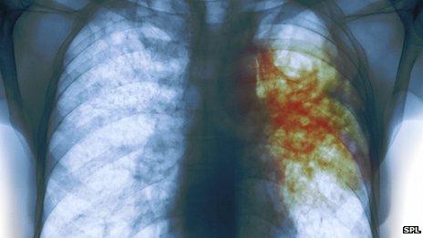 TB in a patient's lung