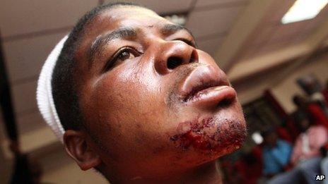 Edwin Machokoto, a Movement For Democratic Change activist shows his blood stained injuries after he was allegedly attacked by suspected Zanu pf supporters in the capital Harare, Friday, March, 15, 2013, on the last day of campaigning before a referendum on a new constitution to be held Saturday.