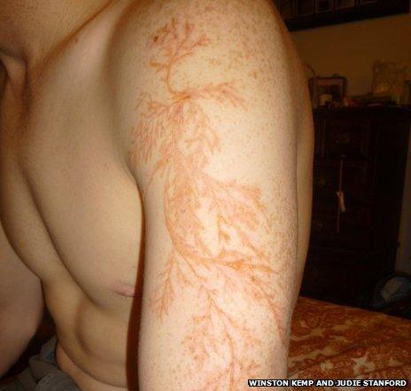 A man's arm with lightning injuries that look like flower or tree branches