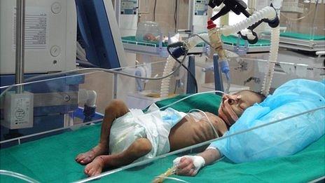 The Low Cost Technology Saving Premature Babies Lives Bbc News