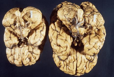 Brain with microcephaly