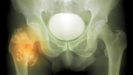 Bone cancer in the hip joint