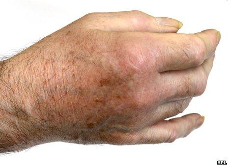 Gout-affected hand