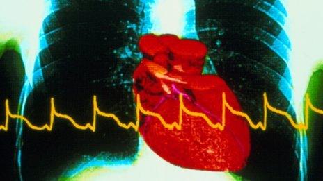 Heart with heart attack trace superimposed