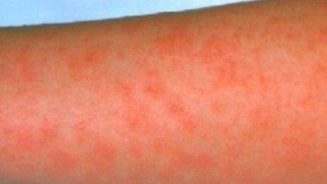 Rise in scarlet fever cases shows 49-year high, health experts say - BBC  News