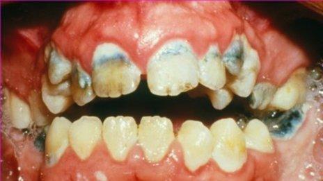decayed teeth