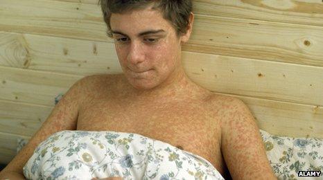 Teenager with measles