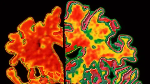 Science Photo Library An image of a brain with Alzheimer's and one without