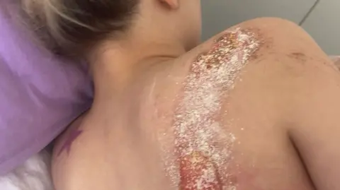 Family A girl lies in a hospital bed facing away from the camera. You can see a bad injury to her right side of her back.