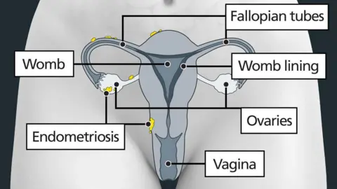 NHS The image shows a diagram of a woman's lower abdomen, with labels identifying the female anatomy. There are yellow clumps visible on the uterus, ovaries and fallopian tubes indicating endometrioma cysts.