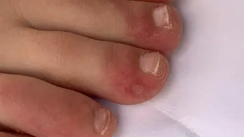 Sores on deals toes