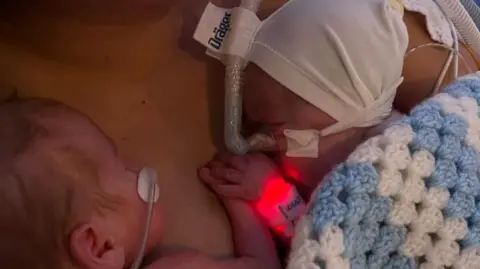 Handout Two babies with breathing tubes lie on their mother's chest, holding hands shortly after being born. One of them is wearing a white cap and they are covered in a blue and white knitted blanket.