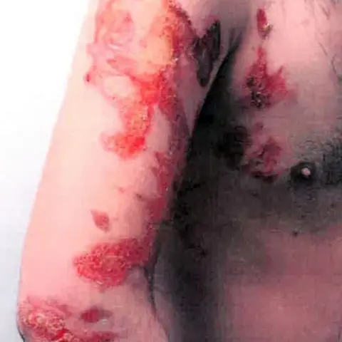 Ben Lack Photraphy A picture of the chef's injuries