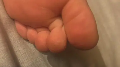 Supplied Child's foot, depicting black spot on his second toe where a weever fish stung him