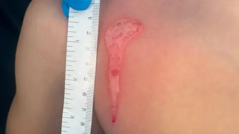 NHS Greater Glasgow and Clyde A close-up of a young boy's chest, with burn marks on it. 