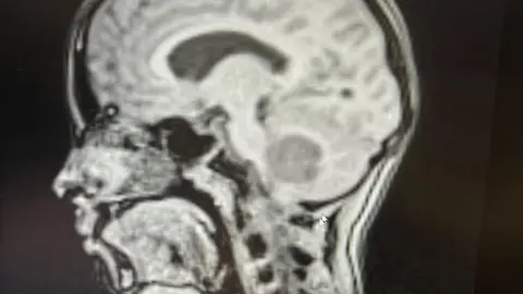 Young Lives vs Cancer  An MRI scan showing the apricot-sized tumour at the base of Amelie's skull and the top of her spine. It is a dark grey patch against the light grey showing the rest of her brain. 