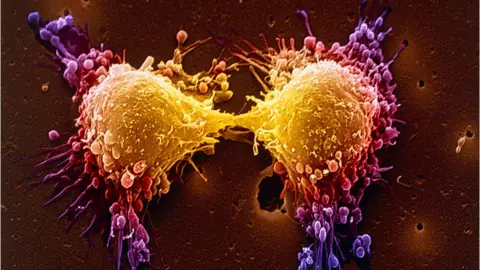 Science Photo Library Prostate cancer cells