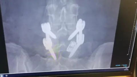 Elanor Ferguson An x-ray showing pins in someone's spine in their lower back